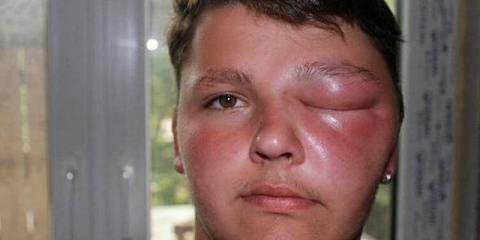 Ubod pčele - kako ublažiti otok